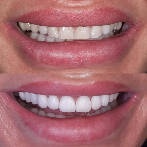 Fațete No Prep Zâmbet perfect fără șlefuirea dinților Stomatologie Râmnicu Sărat